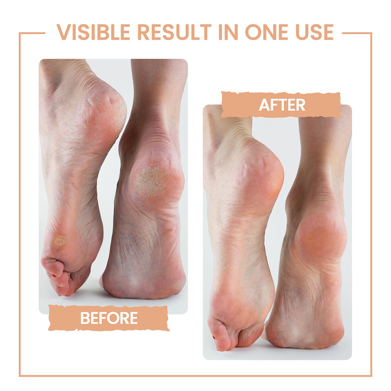 Bliss Pedicure Combo | Instantly Smooth & Soft Feet with A Complete Pedicure Treatment