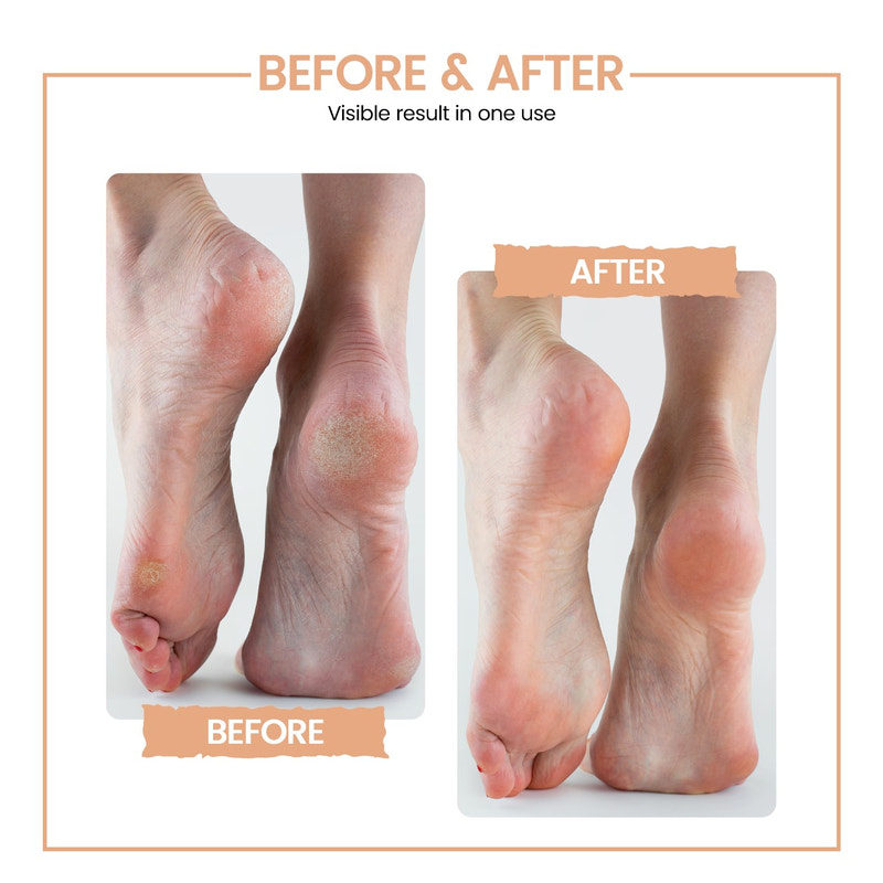 Bliss Callus Remover | Electric home pedicure device for smooth feet